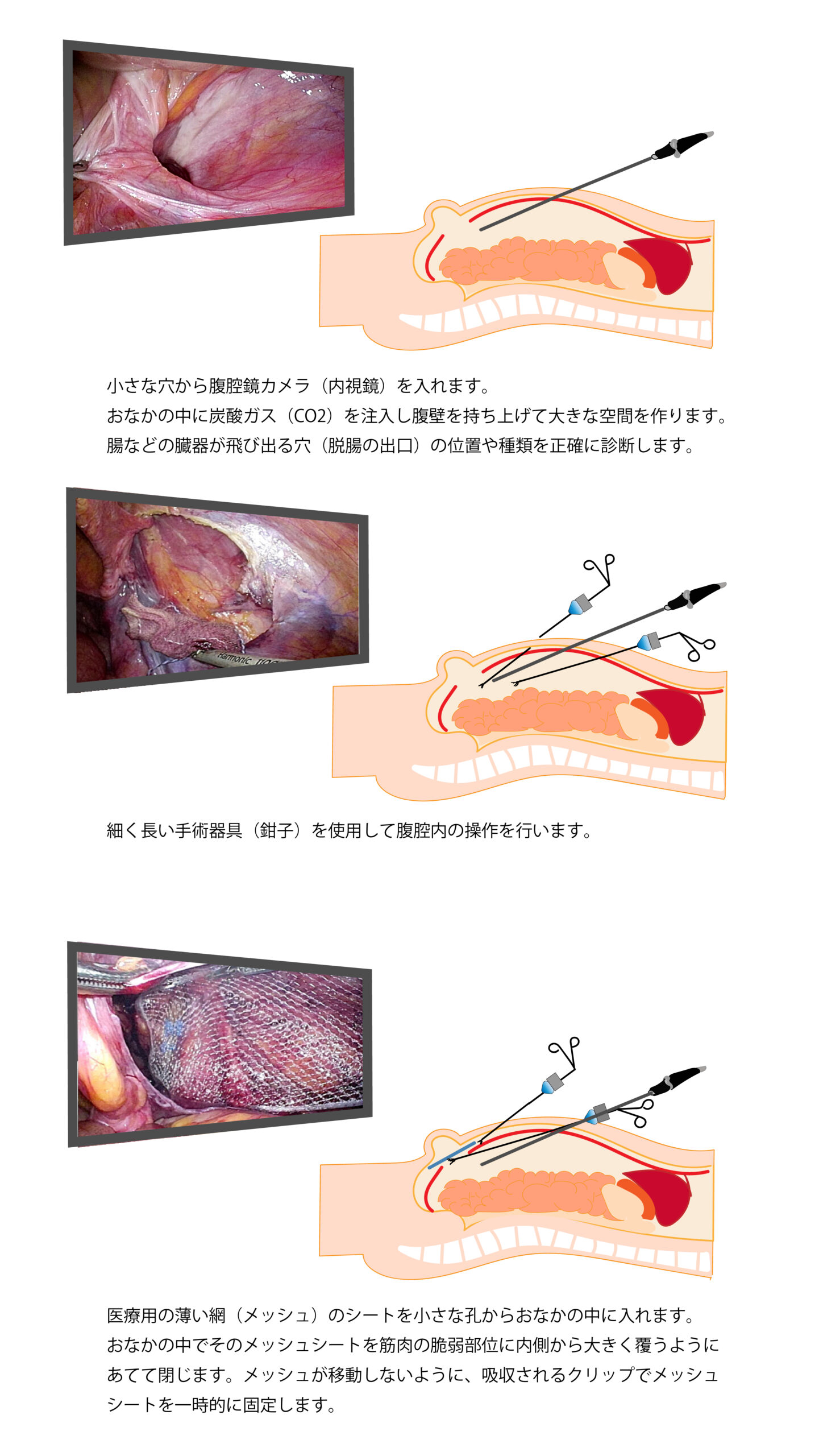 動画でわかる腹腔鏡下鼠径部ヘルニア修復術ーTAPP法のすべてー